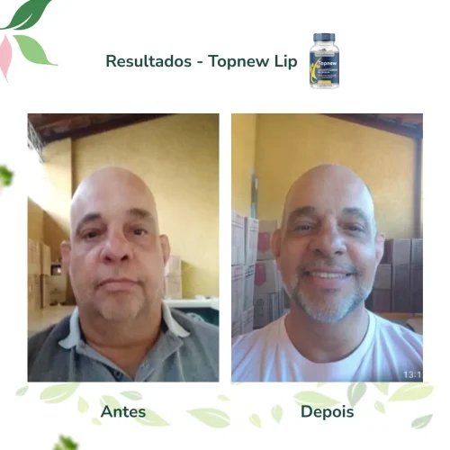 Antes e Depois Topnew Lip - Topnew Suplementos 1